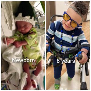 Children with Trisomy 18