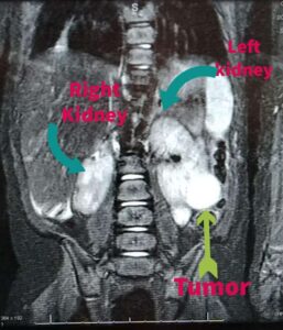 Wilm's Tumor Xray for Trisomy 18 child