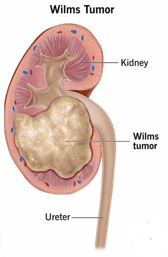 Diagram of Wilms Tumor Kidney